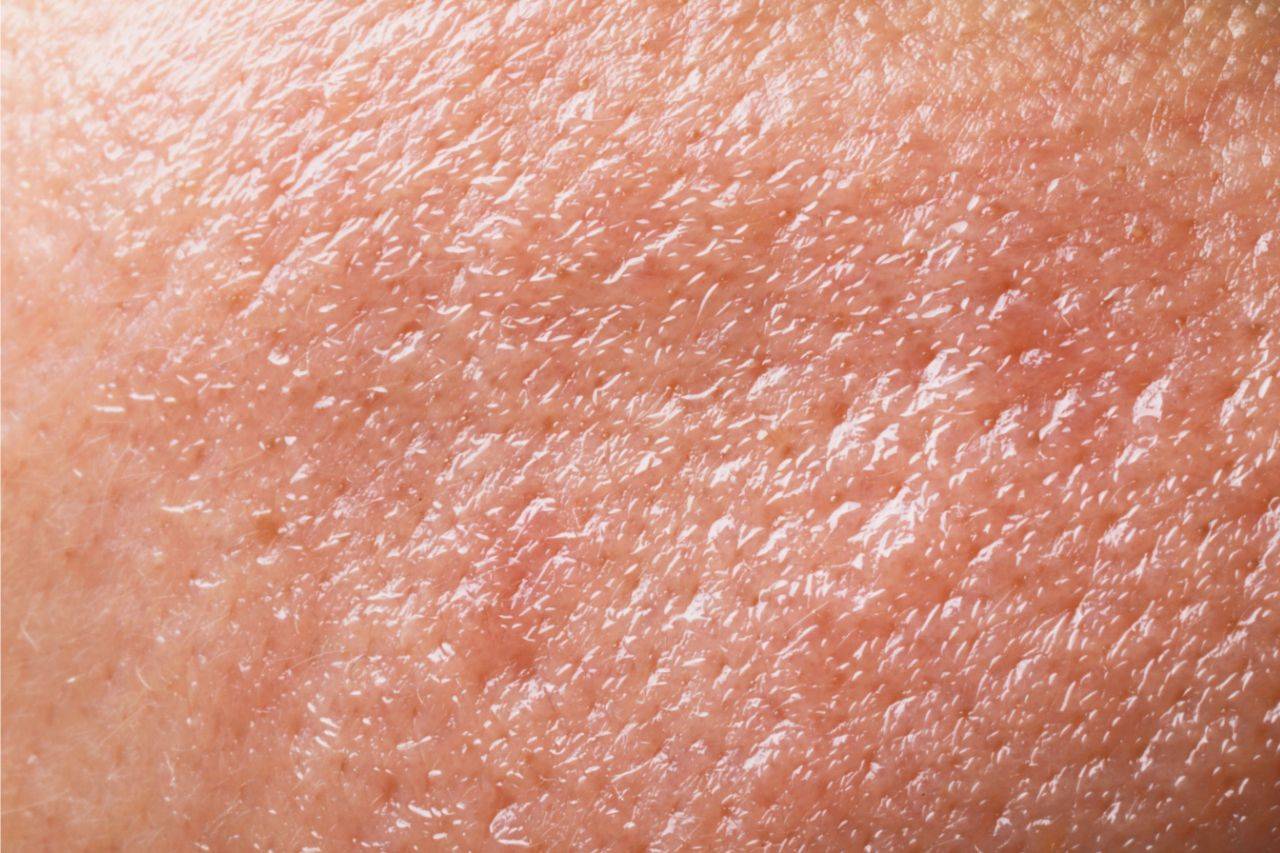 Hauttyp: Fettige Haut – Beitragsbild