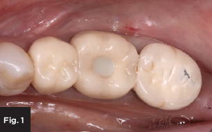 a monolithic zirconia crown in a patient's mouth