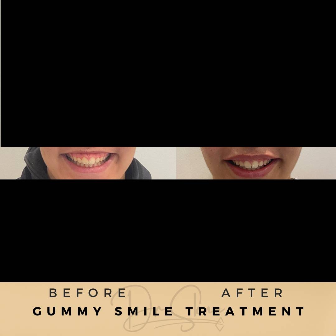 Gummy Smile Treatment Wilmslow Before & After Dr Sknn