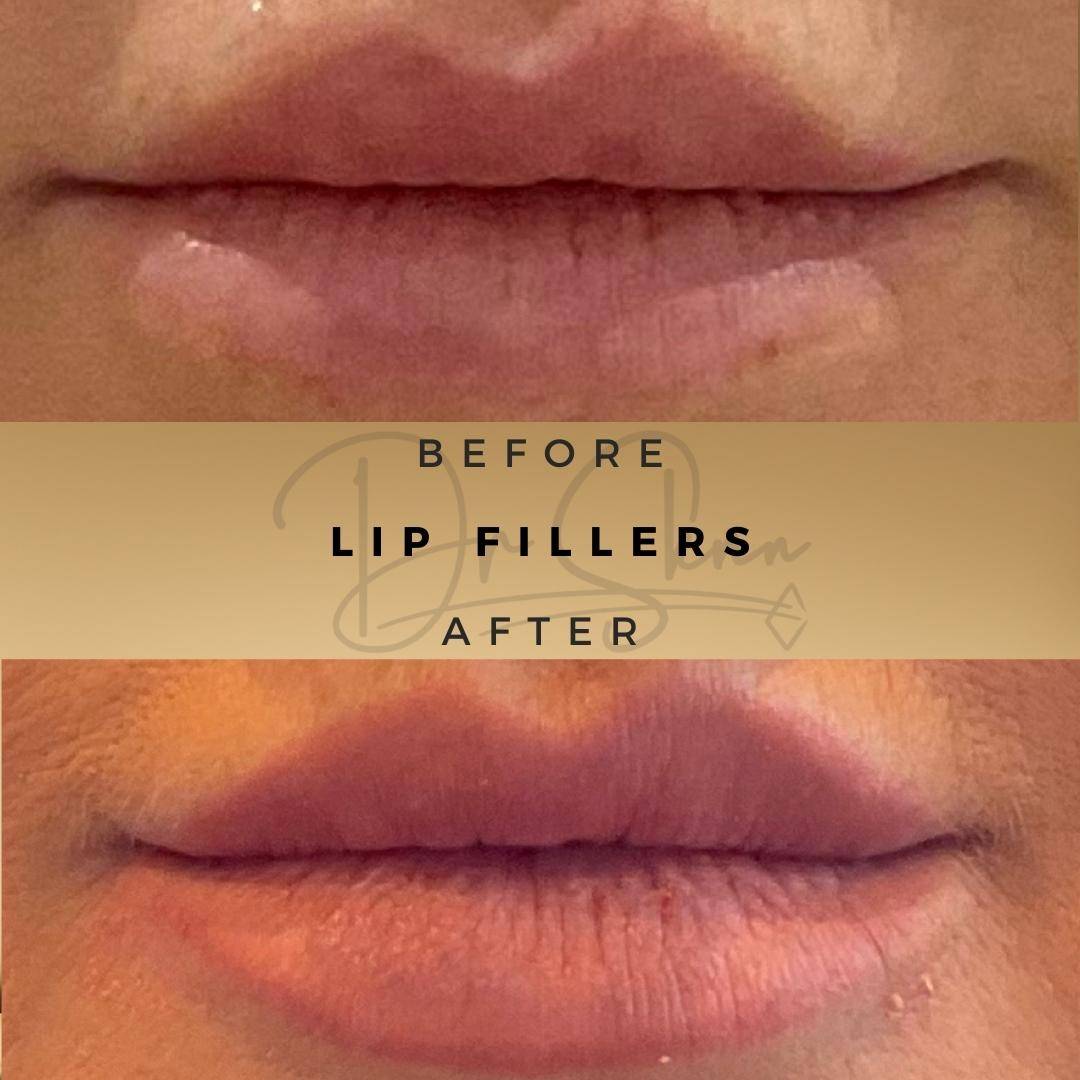 Lip Fillers - Dr Sknn before and after