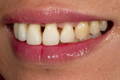 Close-up lateral smile showcasing severe black triangles in upper incisors