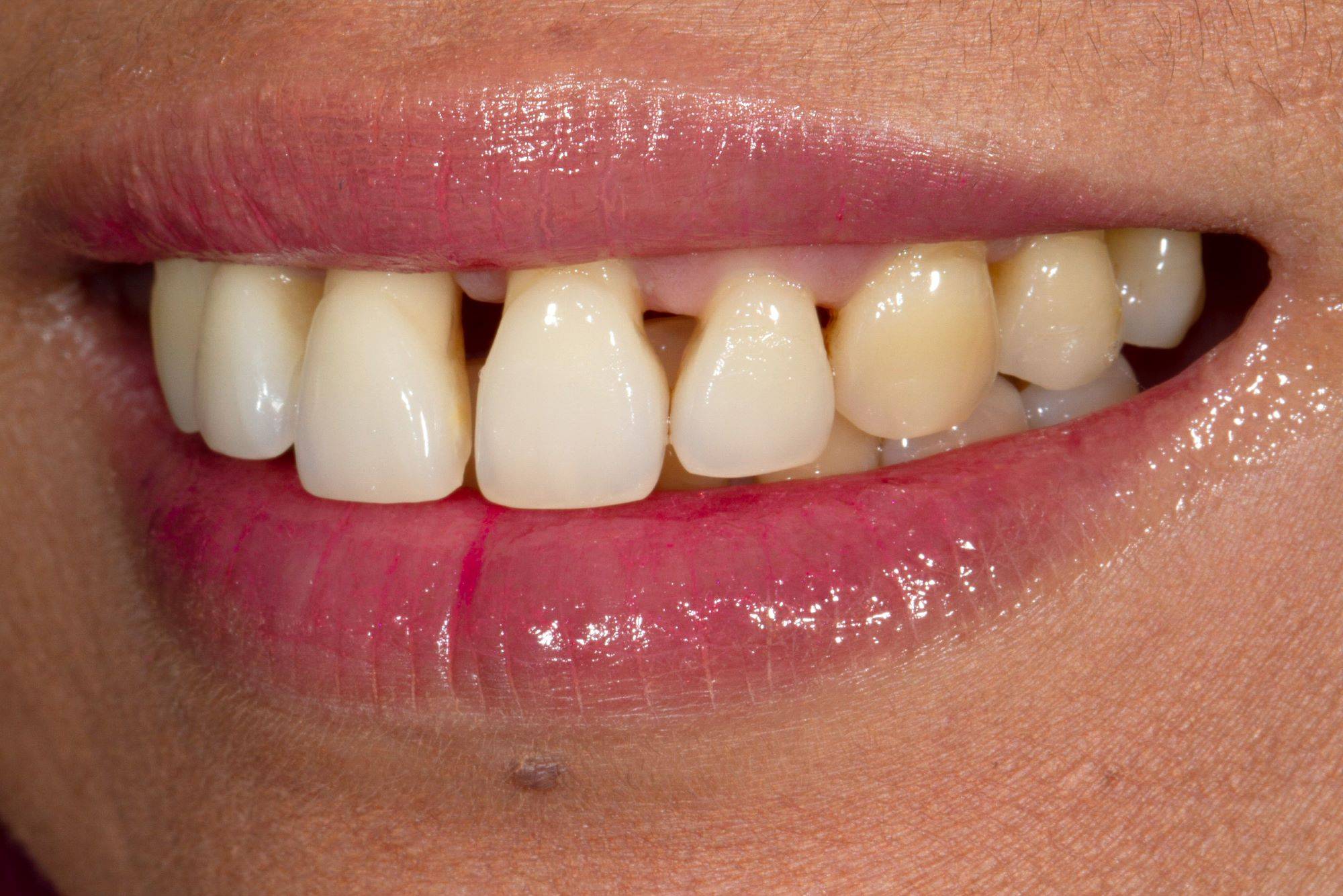 Close-up lateral smile showcasing severe black triangles in upper incisors
