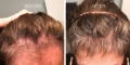 Nulastin-Scalp-Hair-Results-Before-After