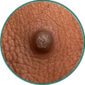 big warts