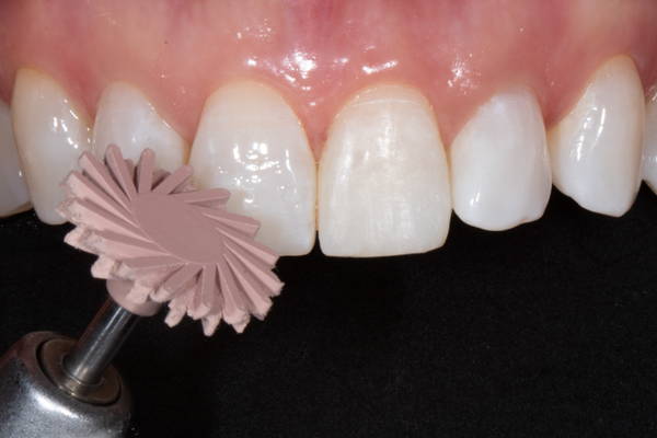 Teeth being polishes with peach polisher