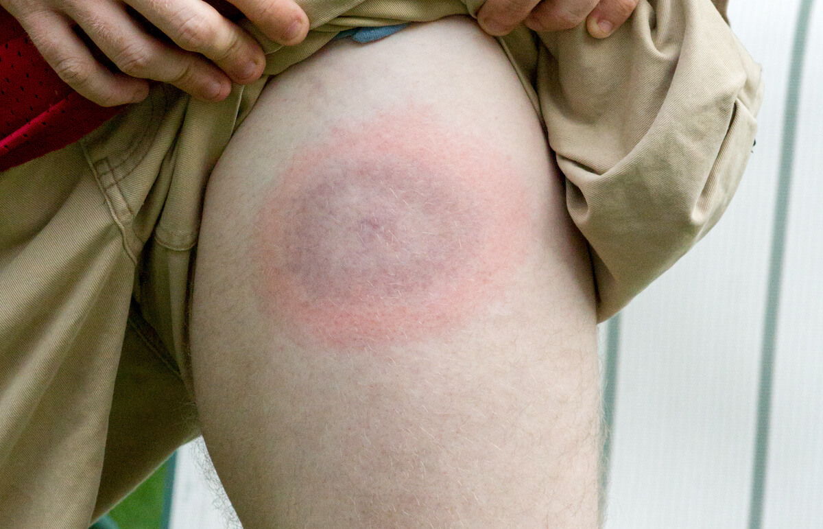 Do You Have These Unusual Symptoms of Lyme Disease? -