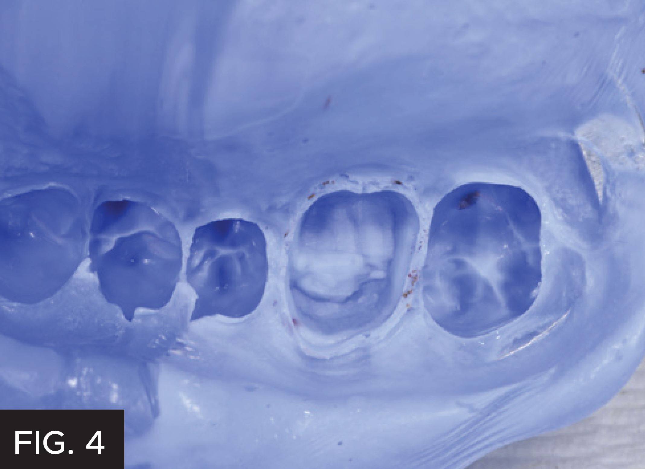 Total cure time is 2:55 min from mix until removal. Final result of a single crown impression.