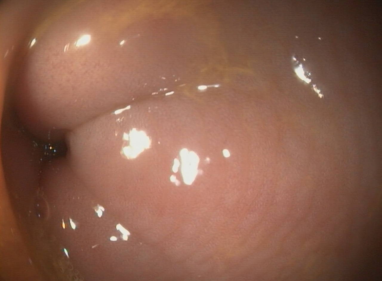 Endoscopie van een gezond darmslijmvlies