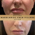 Nasolabial Fold Fillers Wilmslow