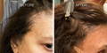 Nulastin-Scalp-Hair-Results-Before-After