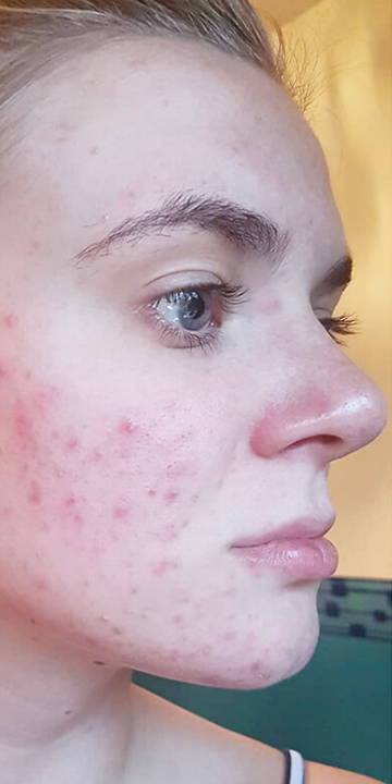 WunderHaut Anti-Aging Genius™ mit Radiofrequenz, LED Licht- und Mesotherapie, EMS und Elektroporation