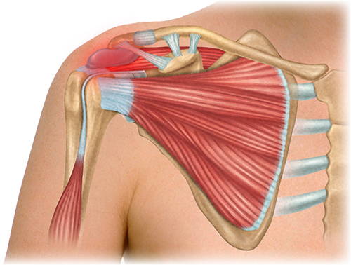 Bursitis Illustration