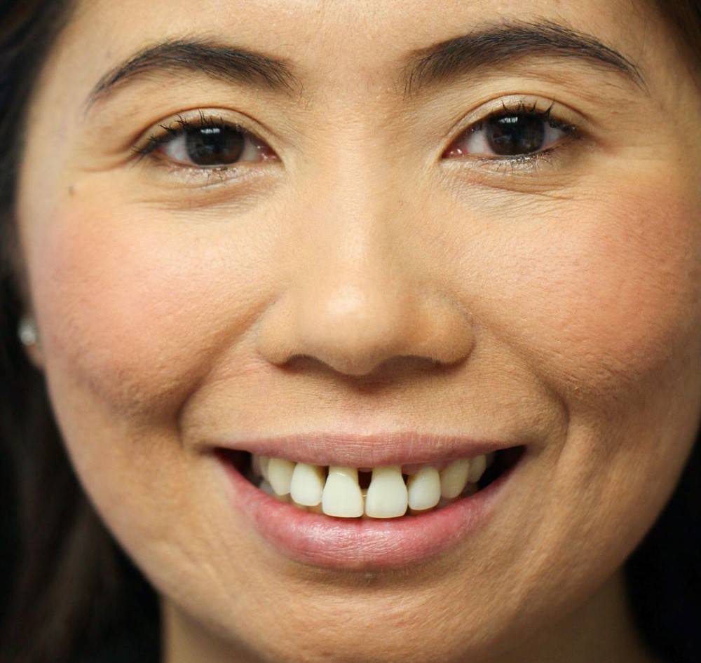 Woman smiling showcasing severe black triangle in upper incisors