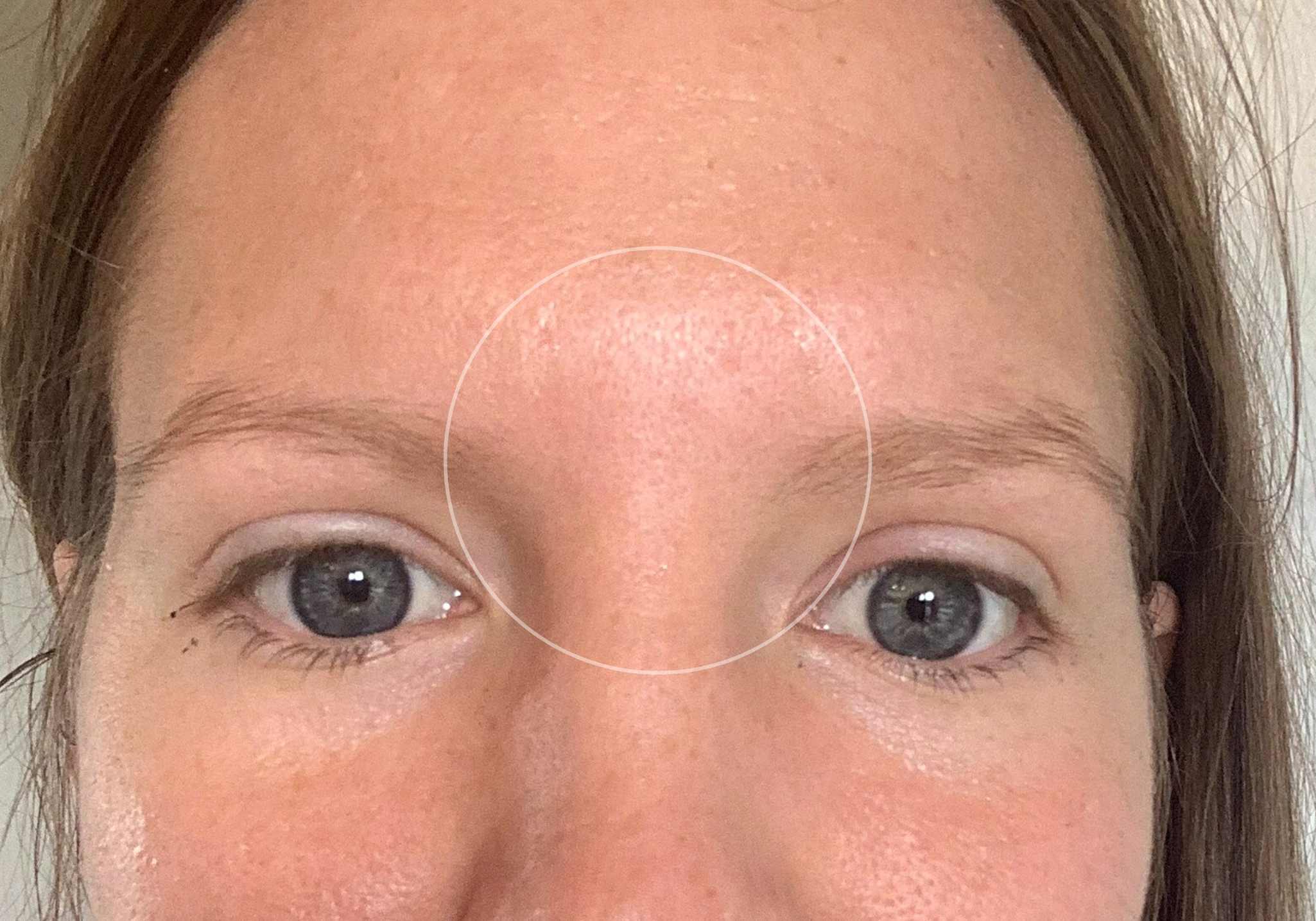 collagen-before-and-after-pictures-wrinkles-forehead-between-eyebrows