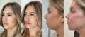 Facial balancing results achieved at California Cosmetics