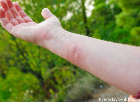 avoid-stings-from-these-pests