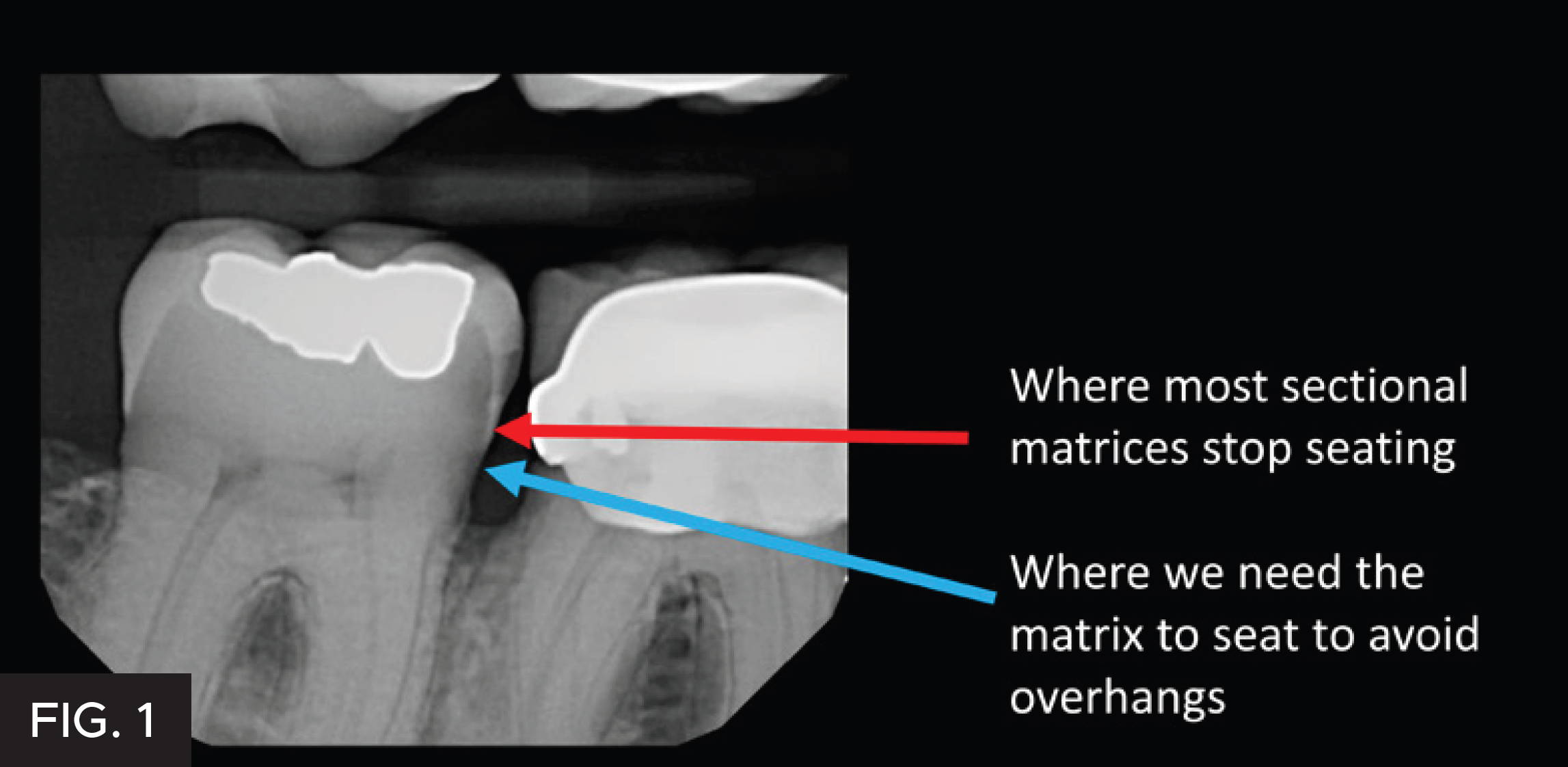 Traditional posterior matrix vs Bioclear matrix