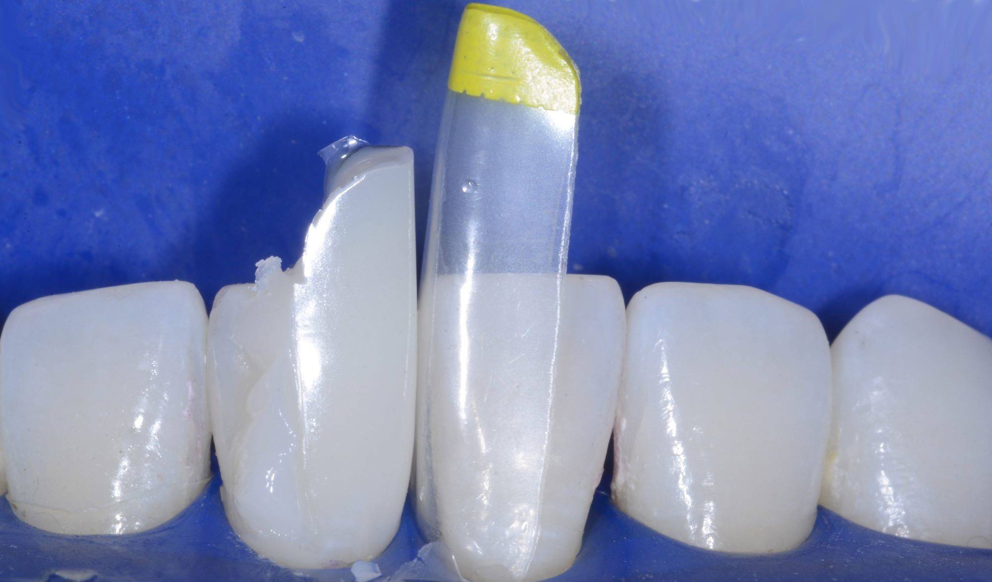 Rubber dam isolated teeth with one molded injected side