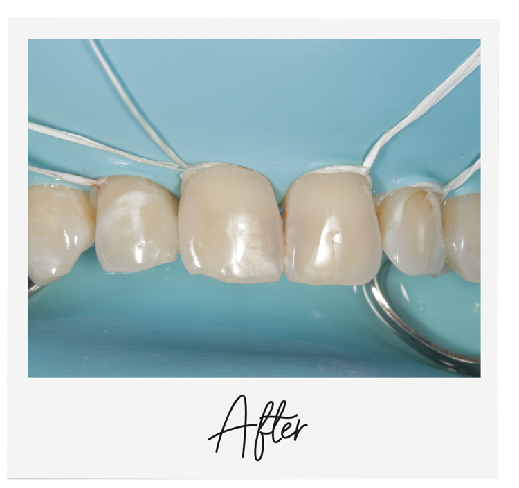 Anterior teeth isolated with dental dam