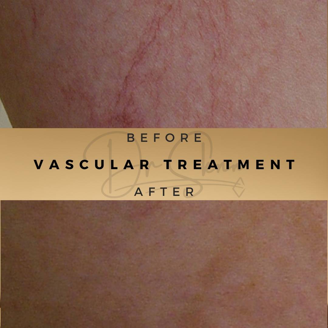 Vascular Treatment Thread Vein Treatment Wilmslow Before & After Dr Sknn