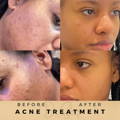 Personalised Skincare for Acne Dr Sknn Before & After Picture
