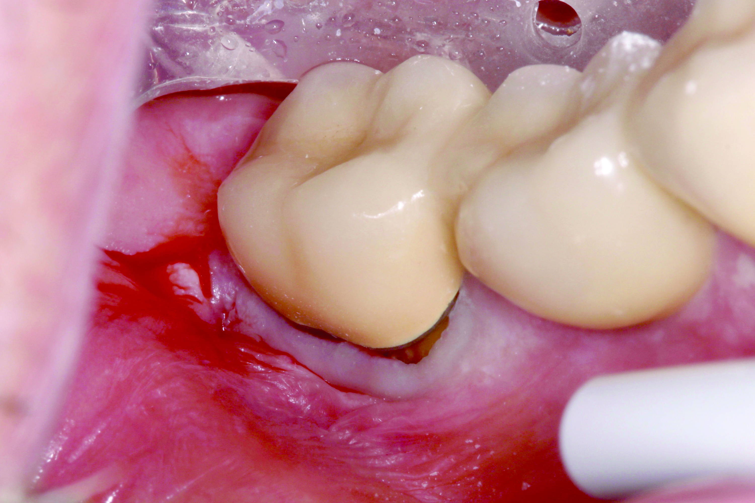 Mesial buccal decay under an existing crown