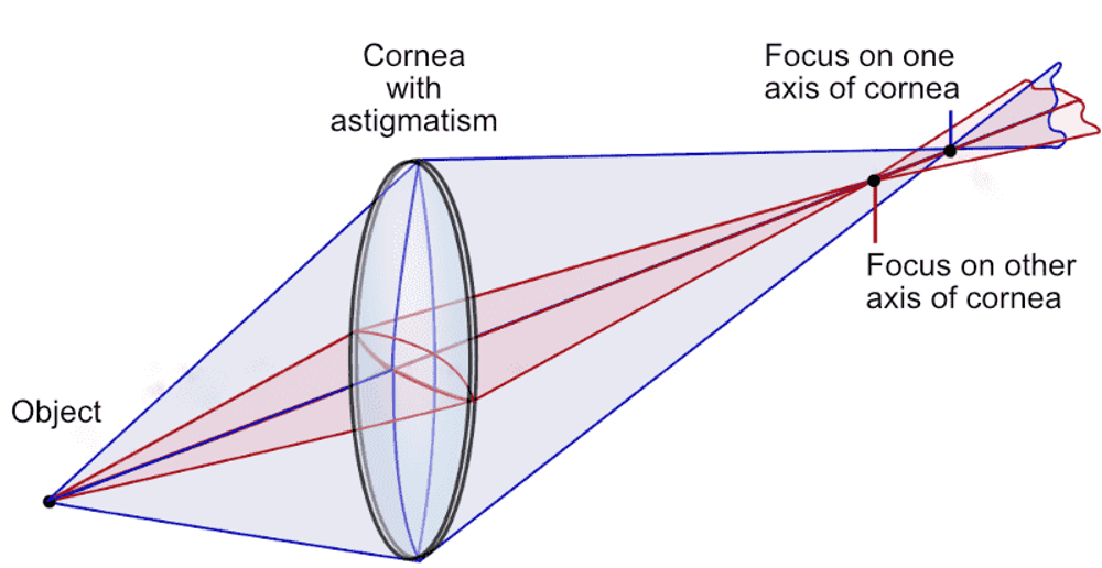 How astigmatism causes vision to be out of focus