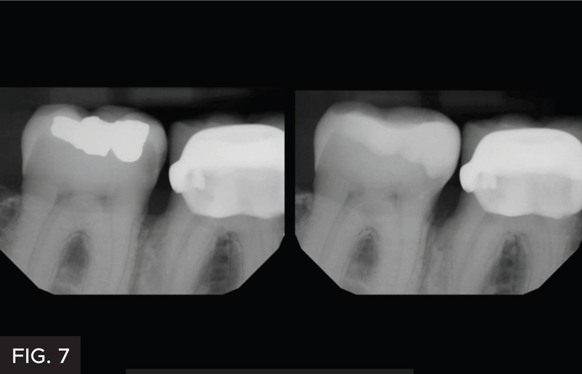 Class II Restoration: Bioclear. Fig. 7