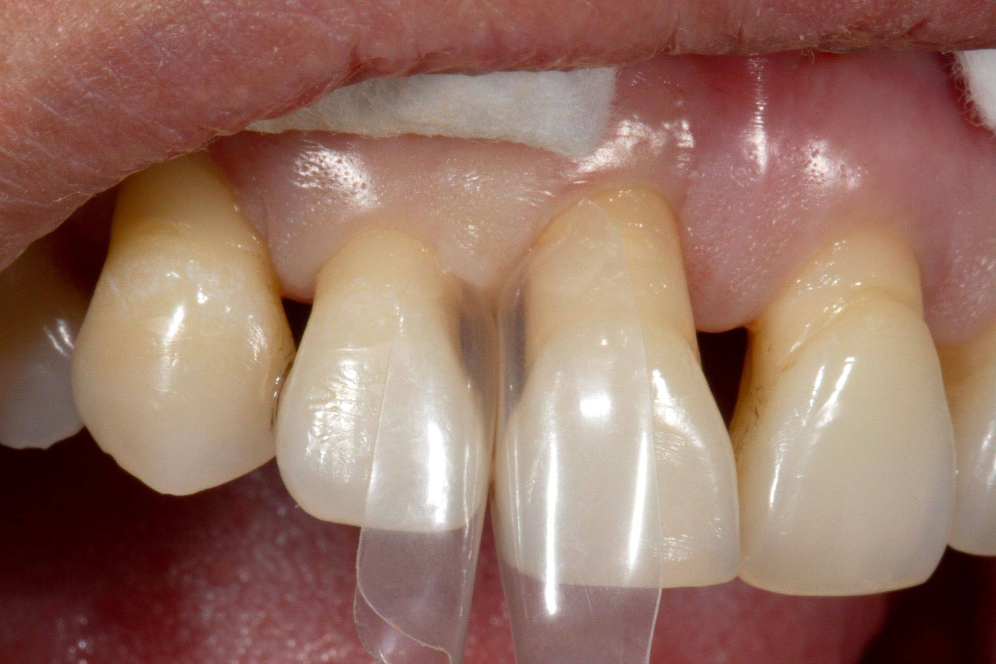 Matrix placed in lateral upper incisors