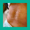 Eczema on Baby's Back | The Milky Box