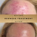 Redness Treatment Wilmslow Dr Sknn Before & After Picture