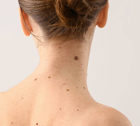 Painless, Scarless Mole Removal. A patients moles are inspected by our expert doctors.