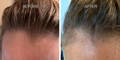 Nulastin-Scalp-Hair-Results-Before-After