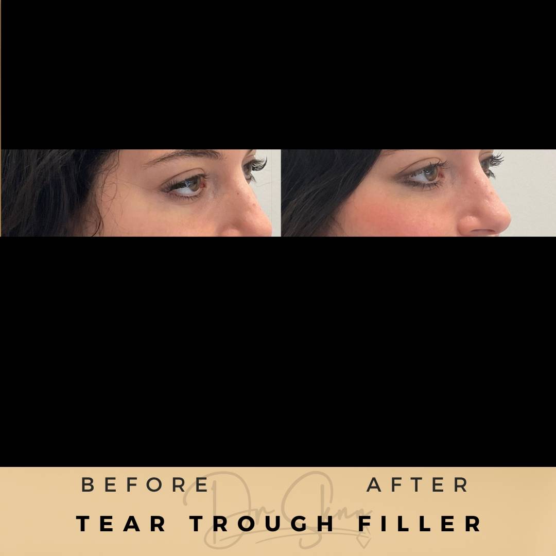 Tear Trough Fillers Wilmslow Before & After Dr Sknn