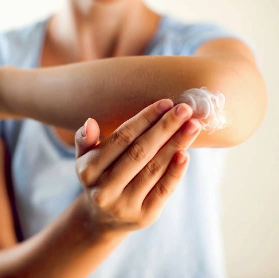Natural Elements Eczema Cream being applied to sore itchy elbow