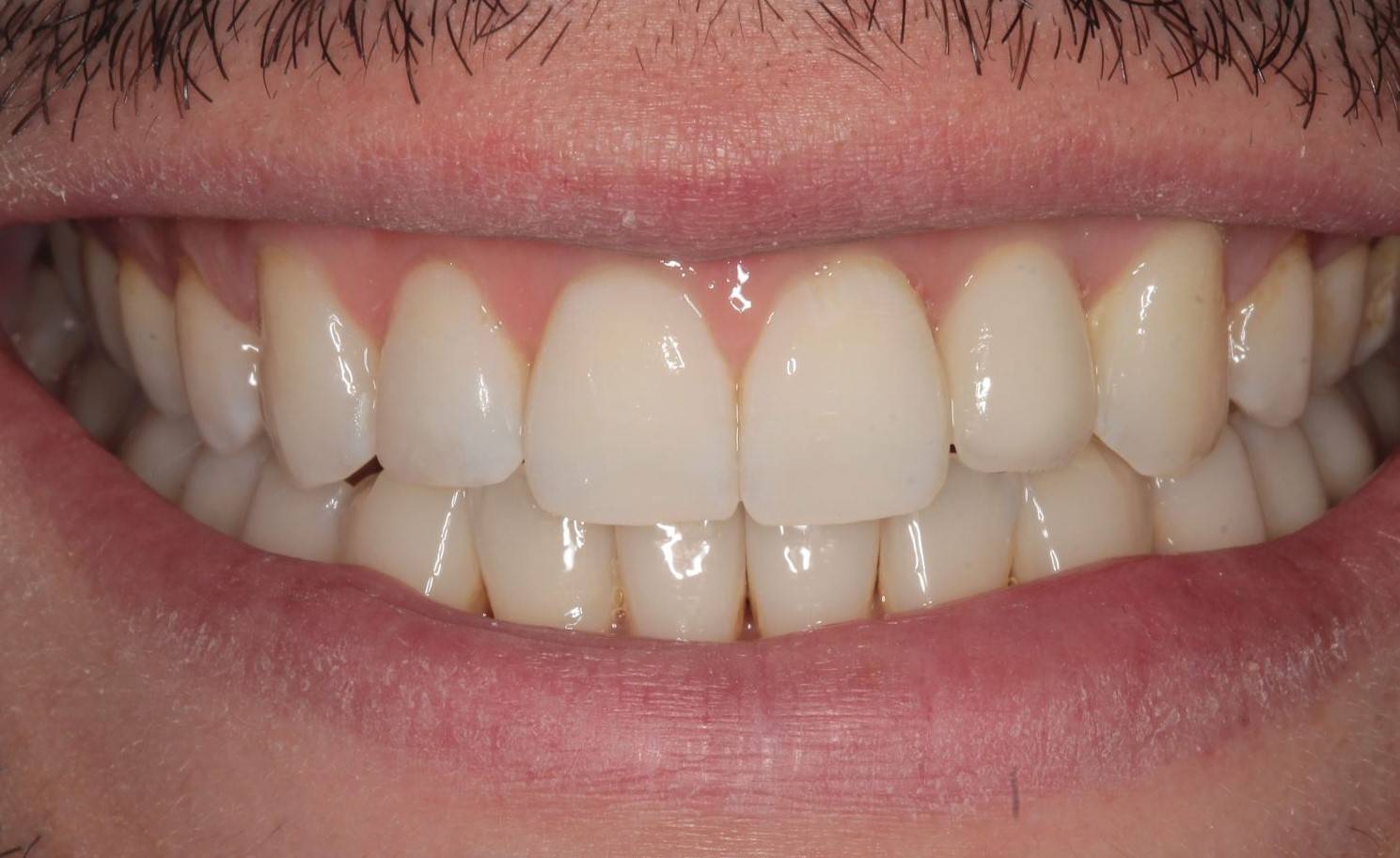 Final result of smiling patient