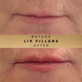 Lip Fillers Wilmslow with Anti-wrinkle injections