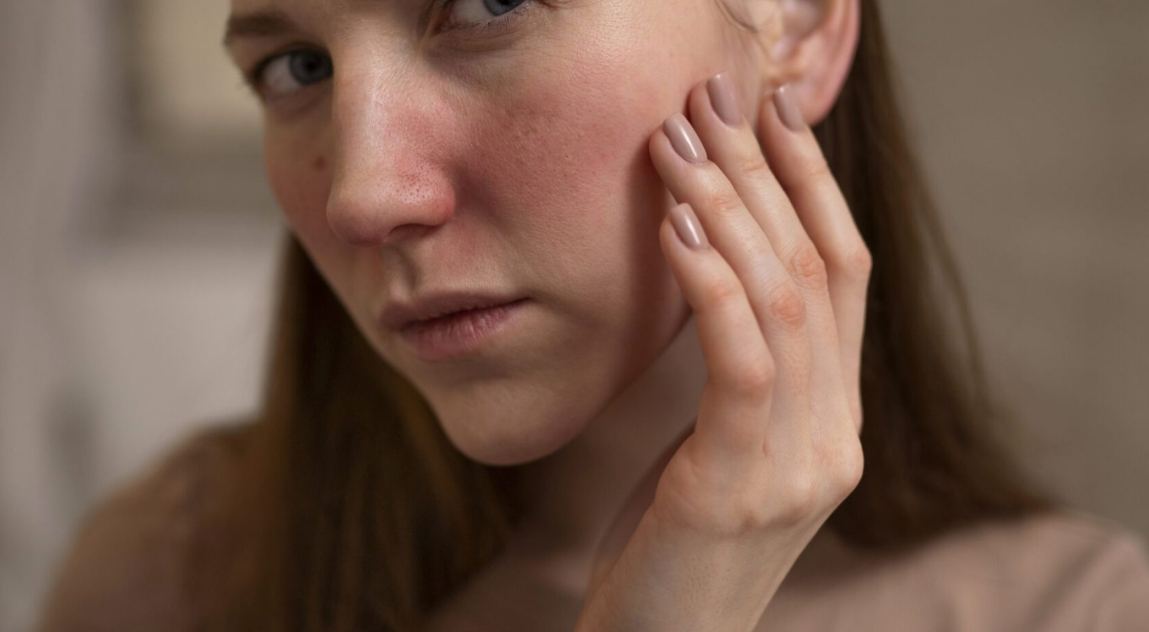 Skin Redness (Dermalogica Pro Calm)