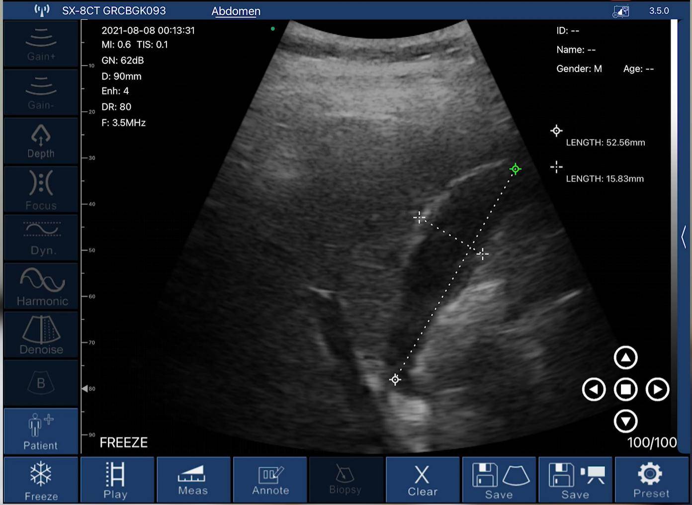 EagleView Handheld-Ultraschall zeigt die gemessene Länge der Gallenblase in der App an.