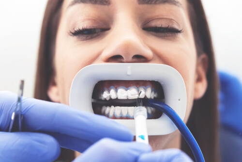 44% hydrogen peroxide teeth whitening gel
