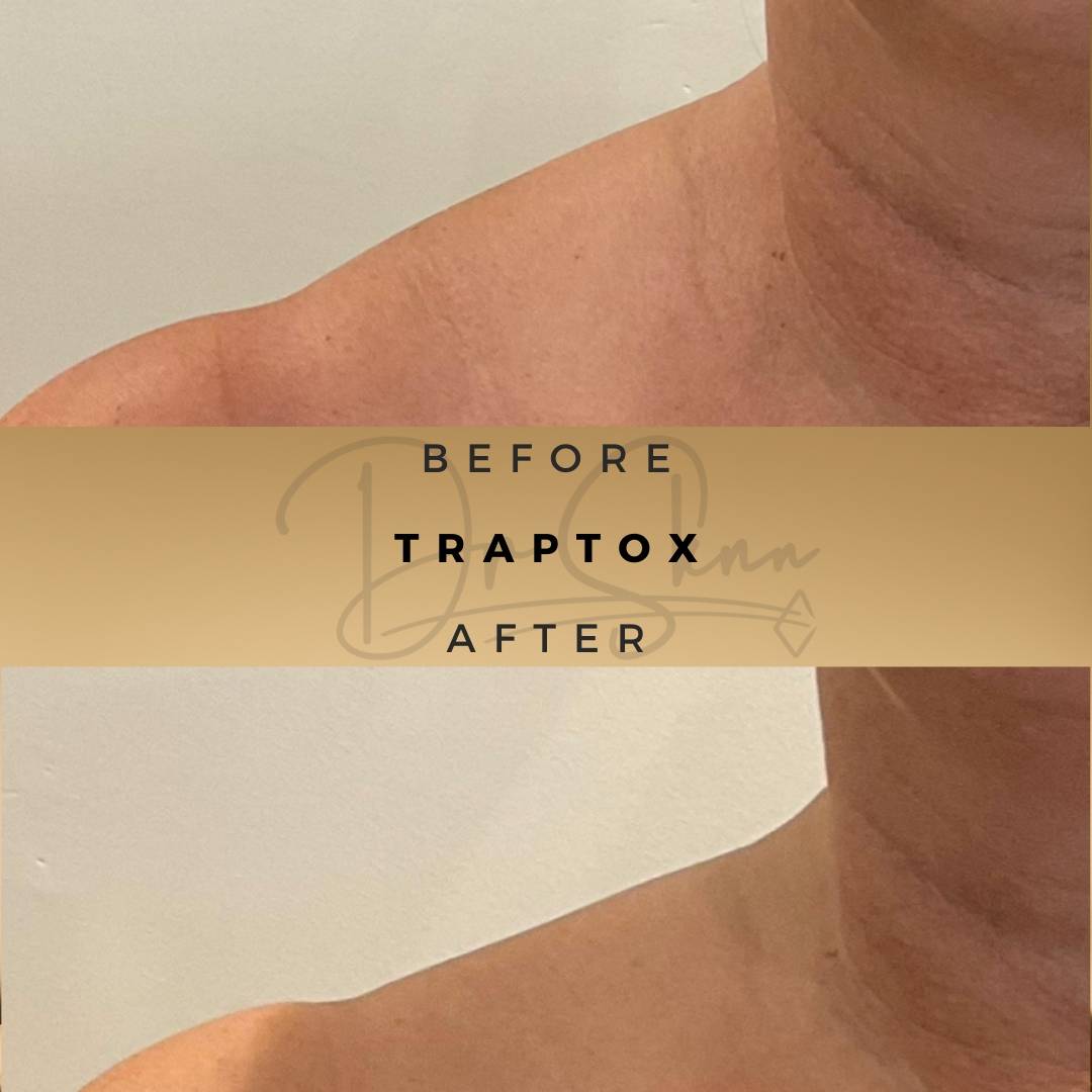 TrapTox Wilmslow Before & After Dr Sknn