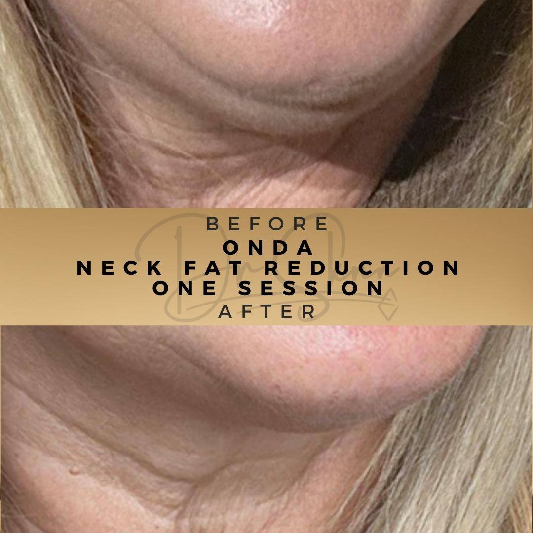 Fat Reduction - Non-surgical - Dr Sknn before and after