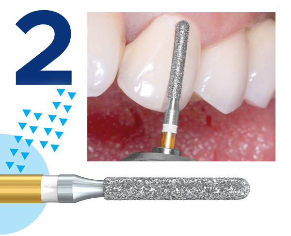 Komet® 4ZR Zirconia Cutter Diamond Crown Removal Bur and a clinical image of crown cutting