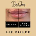 Lip Fillers Wilmslow with Anti-wrinkle injections