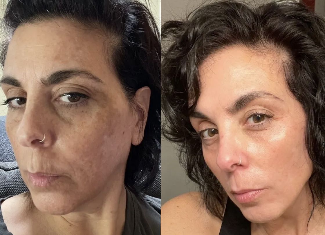 Helen M. before and after