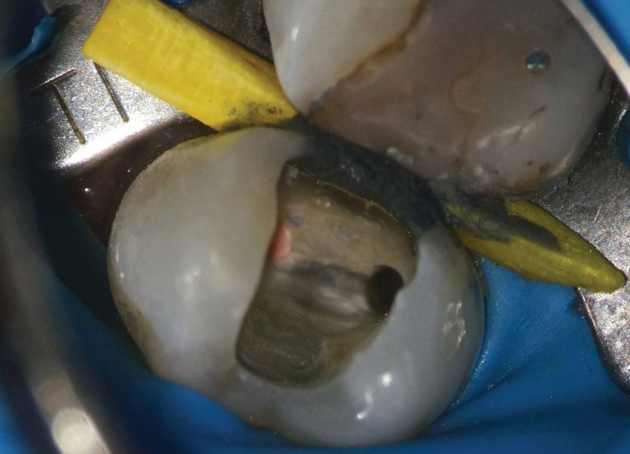 Completed RCT tooth with post space in palatal root