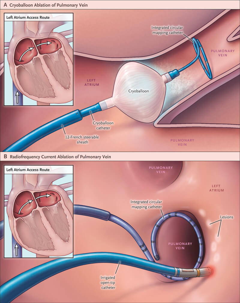 Radiofrequenzablation & Katheterablation