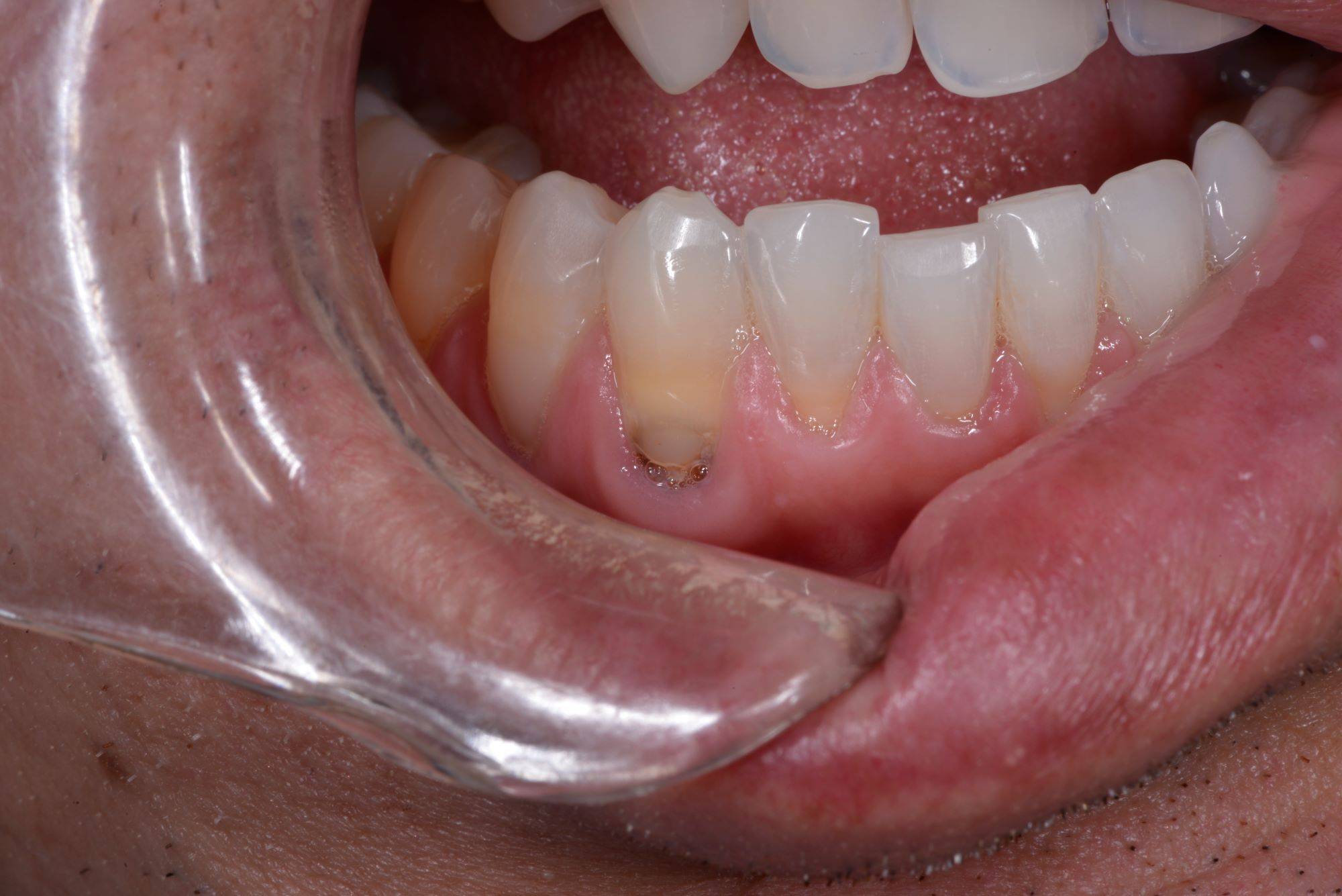 Lipe being pushed by plastic material to show subgingival decay