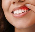 a close-up of a woman's inflamed gums; hyaluronic acid can speed up healing and reduce inflammation