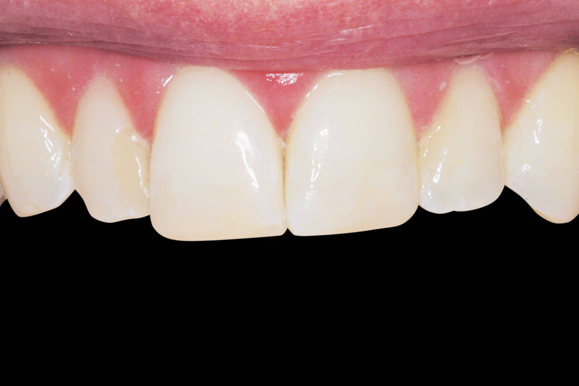 upper teeth after restoration in black background